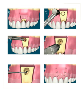 R Section Apicale Ch Teaurenard Dentiste Ch Teaurenard